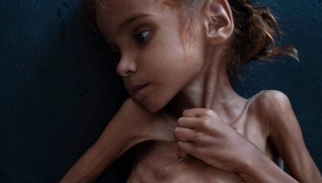 Πέθανε από την πείνα το κορίτσι-σύμβολο του λιμού στην Υεμένη