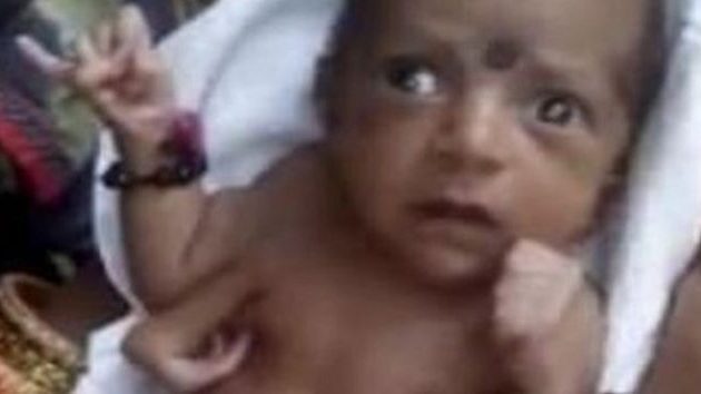 Μωρό στην Ινδία που γεννήθηκε με τρία χέρια το λατρεύουν για θεότητα
