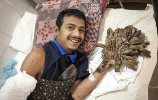 Ξανά στο χειρουργείο ο 28χρονος από το Μπαγκλαντές με τη σπάνια γενετική διαταραχή