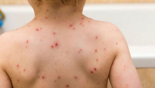 Το υπουργείο Υγείας κήρυξε επιδημία ιλαράς στα Σκόπια