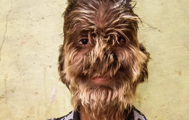 Παιδί-«λυκάνθρωπος» στην Ινδία – Συγκλονιστική εξομολόγηση