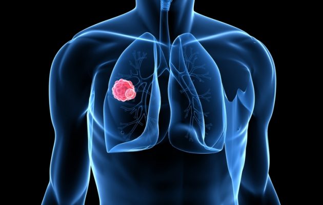 Ποια τροφή μπορεί να εμποδίσει τη μετάσταση του καρκίνου του πνεύμονα