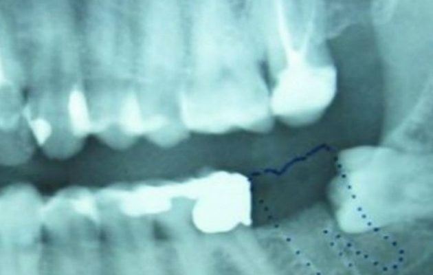 Απίστευτο: Δόντι μεγάλωνε στα γεννητικά όργανα 13χρονου