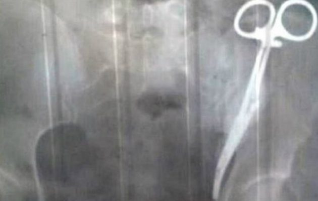 62χρονη είχε για 23 χρόνια ξεχασμένο στην κοιλιά της ένα ψαλίδι