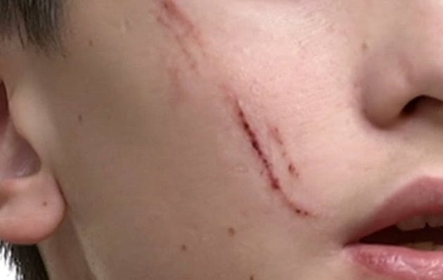 14χρονος «χαράκωσε» με κλειδί στο πρόσωπο συμμαθητή του στην Καλλιθέα (βίντεο)