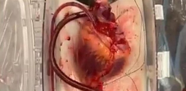 Ιατρικό θαύμα: Γιατροί έκαναν μεταμόσχευση καρδιάς από νεκρό δότη