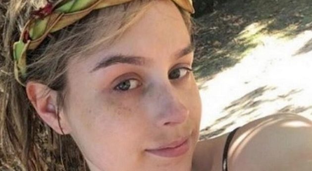 23χρονη επέζησε από έκρηξη ηφαιστείου – Φρικτά εγκαύματα στο σώμα της