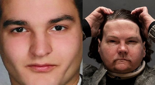 22χρονος ο πρώτος άνθρωπος που λαμβάνει νέο πρόσωπο και χέρια από τον ίδιο δωρητή