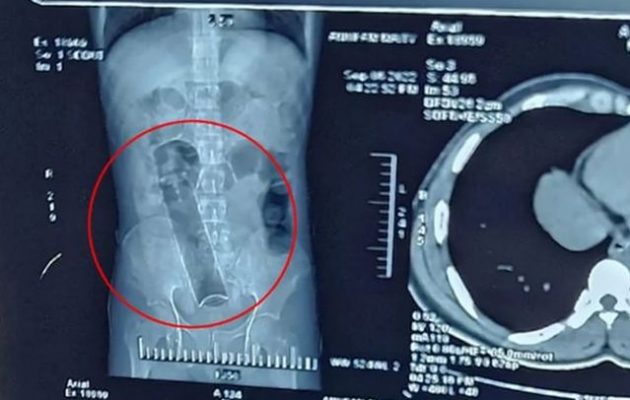 Είχε σφηνωμένο 19 εκατοστών αποσμητικό στον πρωκτό του για 20 μέρες – Οι γιατροί έδωσαν μάχη