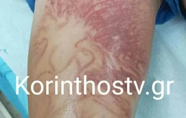 Κόρινθος: Θαλάσσια ανεμώνη τσίμπησε 9χρονο – Μεταφέρθηκε στο νοσοκομείο