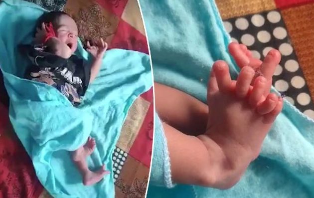 Γεννήθηκε «θεά» στην Ινδία – Μωρό με 26 δάχτυλα, ενθουσιασμένοι οι γονείς