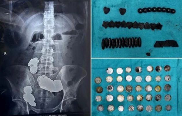 Έφαγε 39 νομίσματα και 37 μαγνήτες επειδή πίστευε ότι ο ψευδάργυρος βοηθάει στο μπόντι μπίλντινγκ