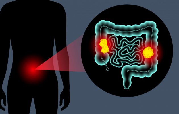 Εξέταση αίματος ανιχνεύει με 83% ακρίβεια τον καρκίνο του παχέος εντέρου