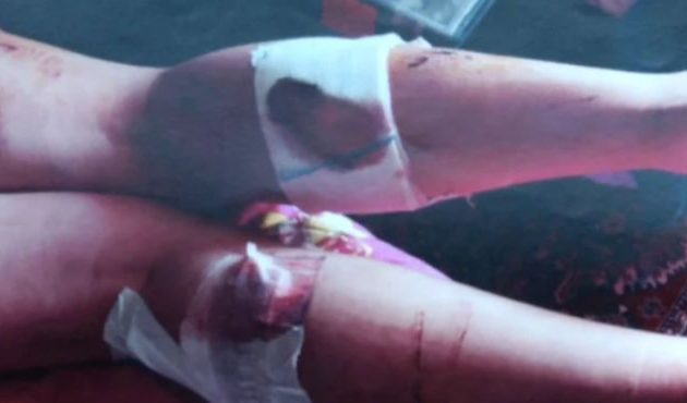 Συγκλονίζουν οι φωτογραφίες από επίθεση σκύλων σε 17χρονη- «Είχε 58 δαγκωματιές»