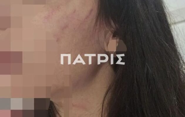 Έζησε ένα εφιαλτικό τριήμερο με τον σύντροφό της – «Την ξυλοκόπησε βάναυσα και την πέταξε στον δρόμο»