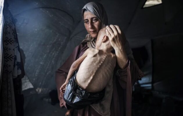 Οι New York Times παραδέχονται ότι το «Πεινασμένο Παλαιστίνιο Παιδί» πάσχει από εκφυλιστική ασθένεια και όχι από λιμό