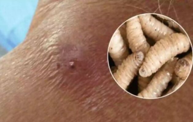 «Σαρκοφάγα αλογόμυγα»: Στις ΗΠΑ εντοπίστηκε το πρώτο κρούσμα σε άνθρωπο